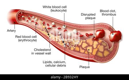 3D-Darstellung der Arterie mit weißen und roten Blutkörperchen, Cholesterin, Lipden, Kalzium und gestörter Plaque mit Thrombus Stockfoto