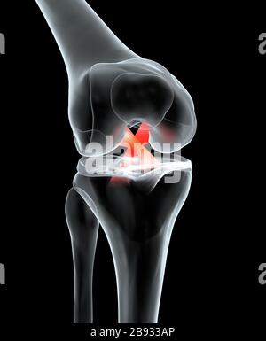 Genaue medizinisch 3D-Abbildung: schmerzhafte Kniegelenk mit hervorgehobenen anterioren und posterioren Kreuzband, Meniskus, Gelenkknorpel Stockfoto