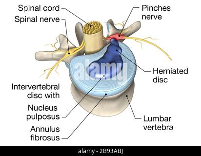 3D-Abbildung mit schmerzhaften Bandscheiben oder Bandscheiben Stockfoto
