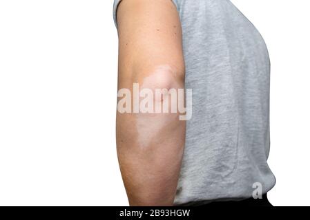 Flecken von Vitiligo an den Ellbogen einer jungen kaukasischen Frau, isoliert auf weißem Hintergrund mit einem Beschneidungspfad. Stockfoto