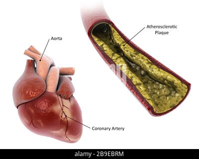 Atherosklerotische Plaque in der Arterie, die zu einem Herzinfarkt führt. Stockfoto