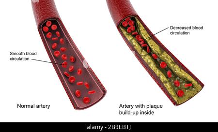 Vergleich einer gesunden Arterie und einer ungesunden Arterie mit Plaque-Aufbau im Inneren. Stockfoto