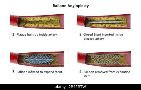 Diagramm mit dem Verfahren der Ballonangioplastie. Stockfoto