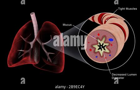 Medizinische Veranschaulichung einer asthmatischen Bronchiole in der menschlichen Lunge. Stockfoto