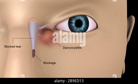 Medizinische Darstellung der Dacryocystitis im menschlichen Auge. Stockfoto