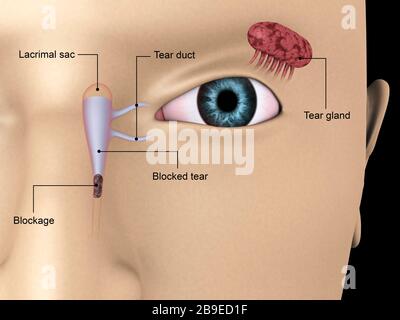 Diagramm mit blockierten Tränenkanälen im menschlichen Auge. Stockfoto