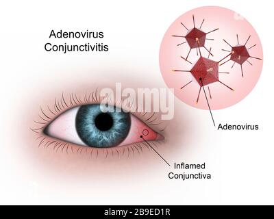 Virale Konjunktivitis im Auge, verursacht durch das Adenovirus. Stockfoto