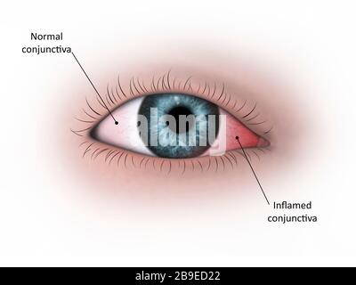 Medizinische Veranschaulichung der Konjunktivitis im menschlichen Auge. Stockfoto