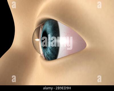 Medizinische Abbildung zeigt Keratoconus im Auge. Stockfoto