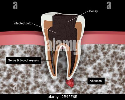 Cutaway-Ansicht einer Zahnhöhle. Stockfoto