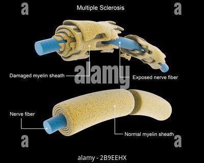 Multiple Sklerose Neuron im Vergleich zu einem normalen Neuron. Stockfoto