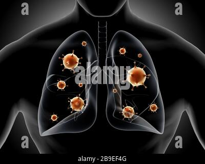 Medizinische Abbildung zeigt Pneumonie in der menschlichen Lunge. Stockfoto