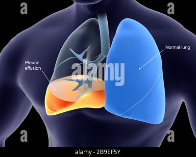 Medizinische Darstellung der Pleurisie in der menschlichen Lunge. Stockfoto