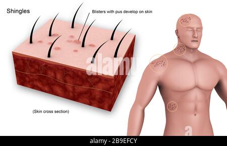 Medizinisches Diagramm mit Schindeln, die durch den Varicella-Zoster-Virus verursacht werden. Stockfoto