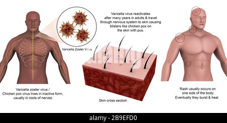 Medizinisches Diagramm mit Schindeln, die durch den Varicella-Zoster-Virus verursacht werden. Stockfoto