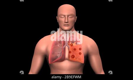 COVID-19-Coronavirus, das die menschliche Lunge infiziert. Stockfoto