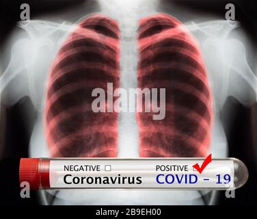 Bluttestschlauch Coronavirus und Röntgenbild des Brustkorbs des Menschen für eine medizinische Diagnose. Covid-19 Pandemien Stockfoto