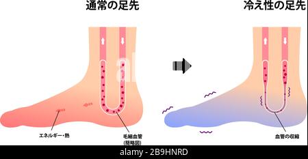 Vergleichsdarstellung des normalen Fußes und des kalten Fußes (Empfindlichkeit gegenüber kalten, kalten Zehen) / Japanisch Stock Vektor
