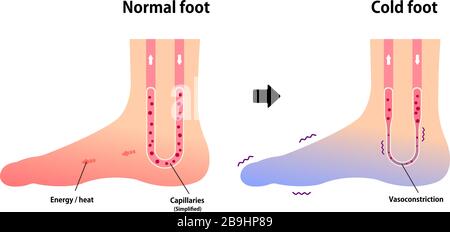 Vergleichsdarstellung des normalen Fußes und des kalten Fußes (Empfindlichkeit gegenüber kalten, kalten Zehen) Stock Vektor