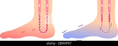 Vergleichsdarstellung des normalen Fußes und des kalten Fußes (Empfindlichkeit gegenüber kalten, kalten Zehen) / kein Text Stock Vektor