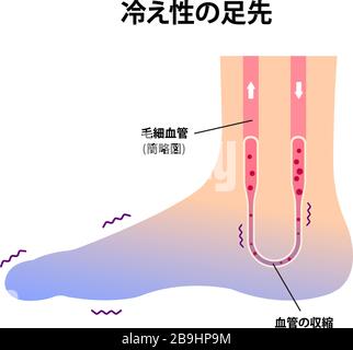 Abbildung der Kaltfußblutzirkulation (Empfindlichkeit gegenüber kalten, kalten Zehen)/Japanisch Stock Vektor