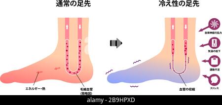 Vergleichsdarstellung des normalen Fußes und des kalten Fußes (Empfindlichkeit gegenüber kalten, kalten Zehen) / Japanisch Stock Vektor