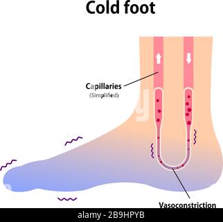 Abbildung der Kaltfußblutzirkulation (Empfindlichkeit gegenüber kalten, kalten Zehen) Stock Vektor