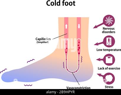 Abbildung der Kaltfußblutzirkulation (Empfindlichkeit gegenüber kalten, kalten Zehen) Stock Vektor