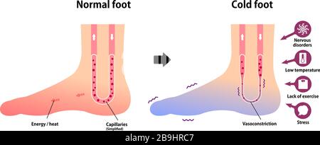 Vergleichsdarstellung des normalen Fußes und des kalten Fußes (Empfindlichkeit gegenüber kalten, kalten Zehen) Stock Vektor