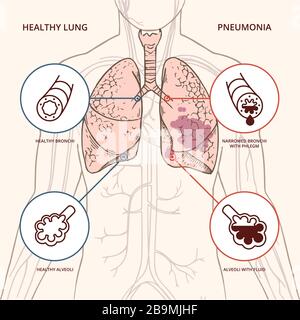 Eine schematische Darstellung des menschlichen Körpers mit einer Infografik der Symptome des Coronavirus kovid 19. Stock Vektor