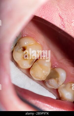 Zahnkaries. Befüllung mit Dentalkomposit-Photopolymer-Material mit Tollern. Das Konzept der Zahnbehandlung in der Zahnklinik Stockfoto