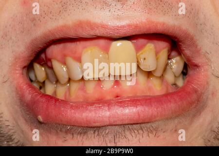 Schlechte Zahnhygiene. Zahnbelag nach dem Rauchen von Zigaretten und nicht beobachten Zahnbürsten Stockfoto