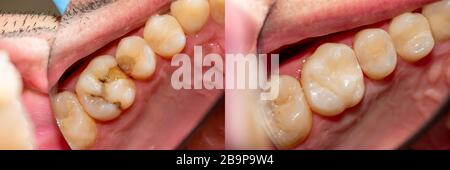 Zahnkaries. Befüllung mit Dentalkomposit-Photopolymer-Material mit Tollern. Das Konzept der Zahnbehandlung in der Zahnklinik Stockfoto