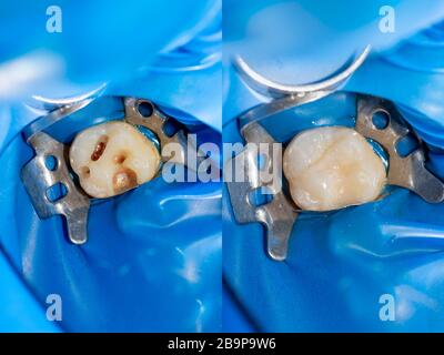 Zahnkaries. Befüllung mit Dentalkomposit-Photopolymer-Material mit Tollern. Das Konzept der Zahnbehandlung in der Zahnklinik Stockfoto