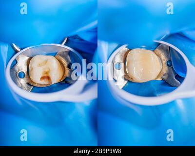 Zahnkaries. Befüllung mit Dentalkomposit-Photopolymer-Material mit Tollern. Das Konzept der Zahnbehandlung in der Zahnklinik Stockfoto