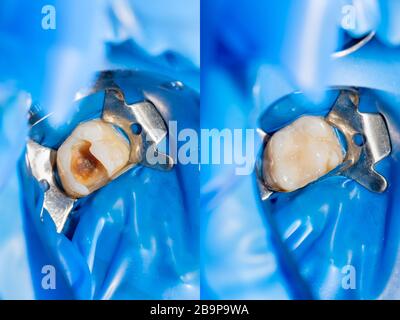 Zahnkaries. Befüllung mit Dentalkomposit-Photopolymer-Material mit Tollern. Das Konzept der Zahnbehandlung in der Zahnklinik Stockfoto