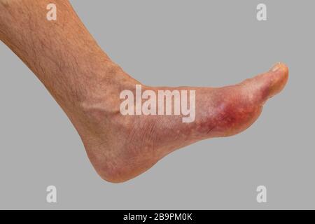 Fußerkrankung Rheuma und Gicht. Schwellung des roten Beins. Schmerzen im Fuß Stockfoto