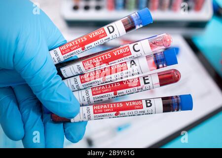 Fiktive Blutproben mit infiziertem Hepatitisvirus, mit Stethoskop, Maske und Spritze und anderem. Stockfoto