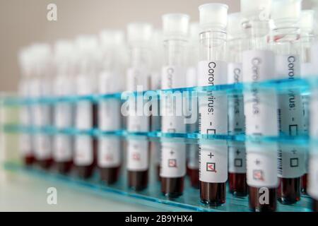 Positive Ergebnisse von Corona-Virustests. Viele Blutproben in einem speziellen Laborhalter. Stockfoto
