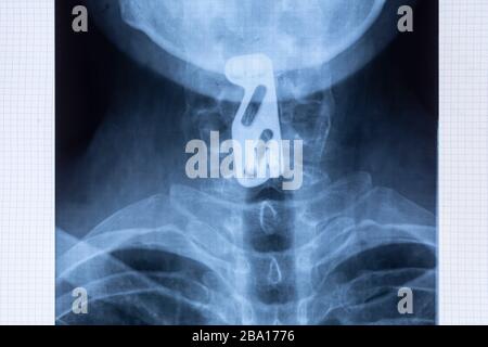 Radiographie der Titan-Platte-Fixierung zur Unterstützung der Halswirbelsäule nach C5- und C6-Wirbelverletzungen. Nackenstabilität mit Spinalinstrumenta Stockfoto