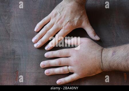 Eine geschwollene Faust aus einem Stachel einer Wespe im Vergleich zu einer gesunden Faust über dunklem Holzhintergrund Stockfoto