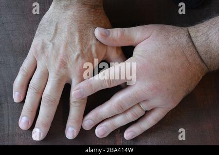 Eine geschwollene Faust aus einem Stachel einer Wespe im Vergleich zu einer gesunden Faust über dunklem Holzhintergrund, Nahansicht Stockfoto