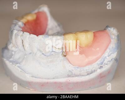 Künstliche Zahnprothese. Modell der menschlichen Zähne. Zahnguss mit abnehmbarem partiellem Gebiss auf dunklem Holzhintergrund. Stockfoto