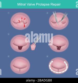 Reparatur Des Mitralklappenprolaps. Die Methode zur Reparatur des Herzventils durch einen chirurgischen Eingriff entfernte beschädigte oder abnorme durchgesickerte Segmente und verwendete einen synthetischen Materialring (ME Stock Vektor