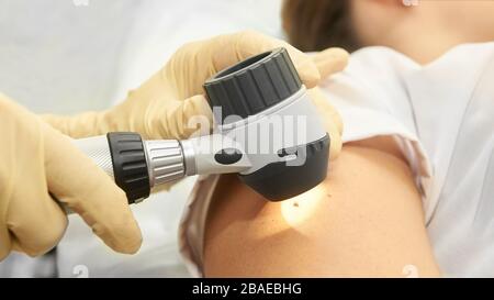 Maulwurf im Krankenhaus prüfen. Hände mit Handschuhen in den Händen halten Stockfoto