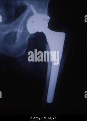 Künstliches Hüftgelenk im Röntgenbild des menschlichen Oberschenkels Stockfoto
