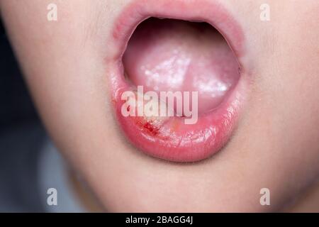 Kranker Junge mit großem Dunst an den Lippen Stockfoto