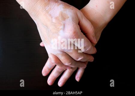 Die Hände der Frau gefaltet. Die Haut ist mit Vitiligo befleckt. Vitiligo an den Händen einer Frau im Alter. Stockfoto