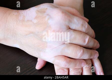 Die Hände der Frau gefaltet. Die Haut ist mit Vitiligo befleckt. Vitiligo an den Händen einer Frau im Alter. Stockfoto