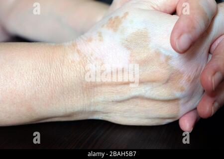 Die Hände der Frau gefaltet. Die Haut ist mit Vitiligo befleckt. Vitiligo an den Händen einer Frau im Alter. Stockfoto